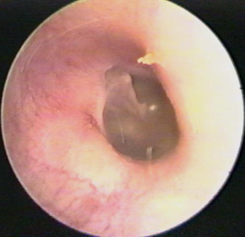 ear wax build up