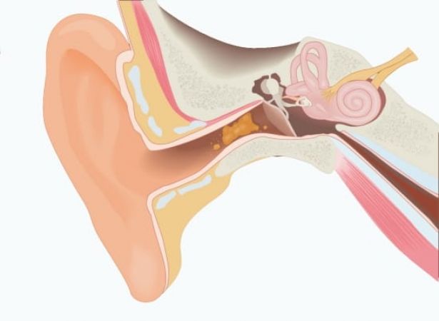 The Dangers of Excessive Earwax